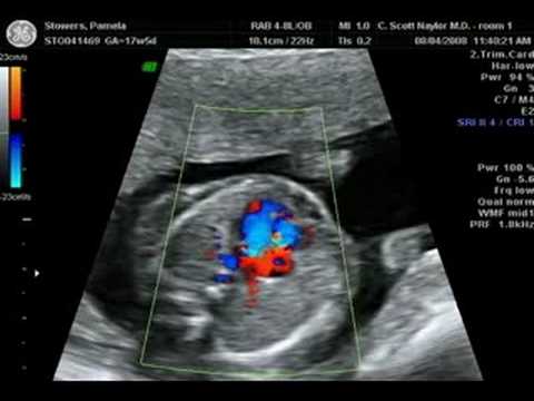 Pam Stowers Baby Ultrasound