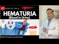 Hematuria: Dugo sa ihi (Symptoms, Causes, Diagnosis & Treatment)