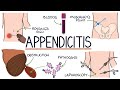 Understanding appendicitis