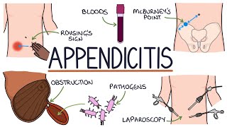 Understanding Appendicitis