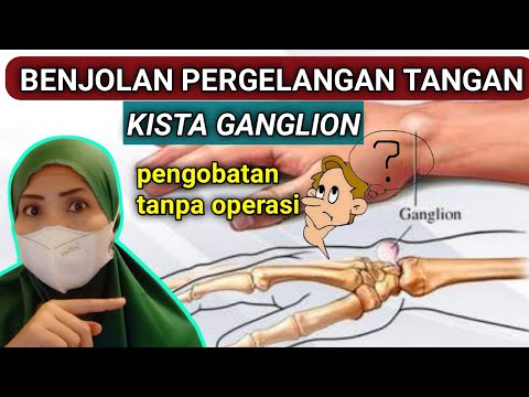 Video: Mengapa ganglion datang semula?