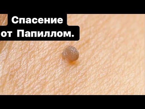 Папилломы отсохнут! Всего 2 аптечных средства спасут от папиллом - YouTube
