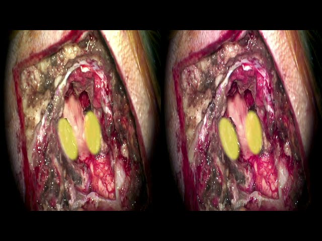 Suboccipital craniectomy with bilateral cerebellomedullary fissure dissection for resection of a...