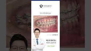 #덧니교정 #치아교정과정 #바르다교정치과 #건대치과