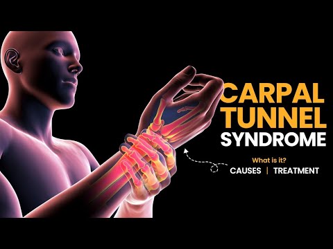 Carpal Tunnel Syndrome: What is it? Causes and Treatment Options