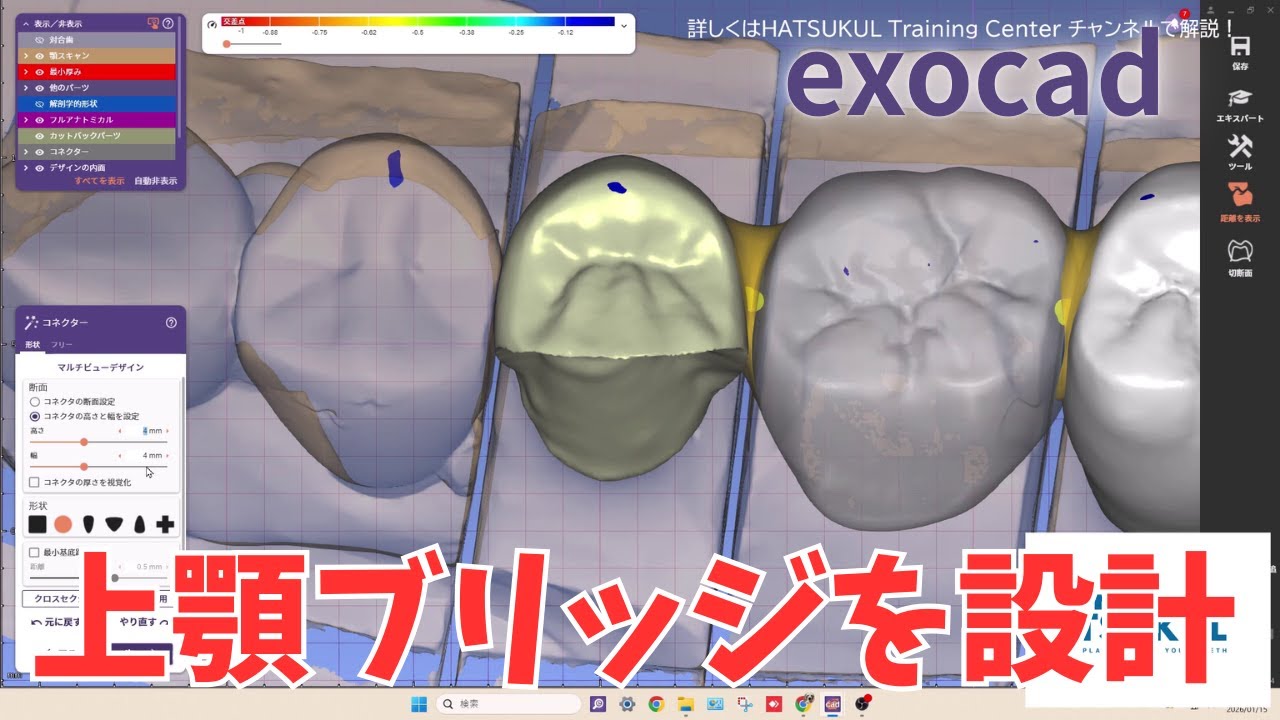 #315　exocad設計　上顎ブリッジを設計！（解説なし版）