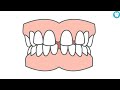 How To Close Gaps Between Teeth (Without Braces)