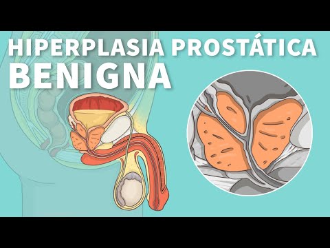 Video: ¿La hiperplasia prostática benigna es cancerosa?