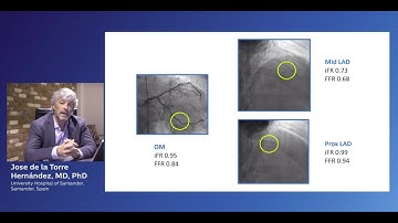 Case review: iFR Co-registration in distal LM and LAD with Dr. Jose de la Torre Hernandez