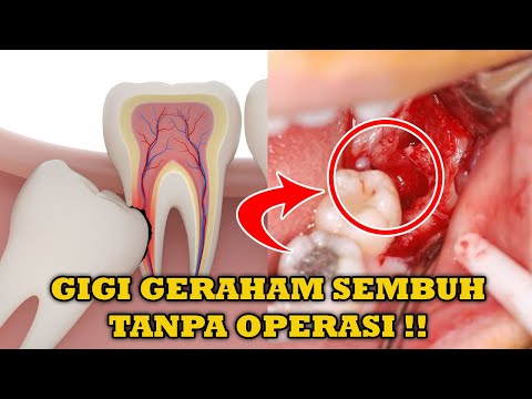 DR OZ - Jangan Anggap Remeh Sakit Gigi (15/9/18) Part 4. 