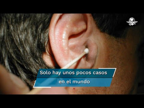 Video: ¿La pérdida de audición es un síntoma de covid?