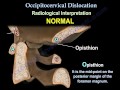 Occipitocervical Dislocation - Everything You Need To Know - Dr. Nabil Ebraheim