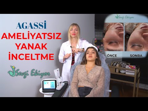 Agassi - Ameliyatsız Yanak İnceltme