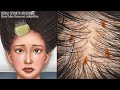 ASMR 소름주의! 근질근질 머릿니 속 시원하게 제거하기 | 지루성 피부염 치료 | Get rid of tons of head lice