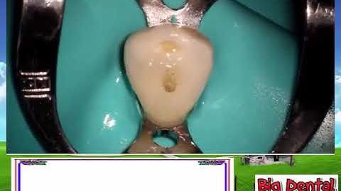 B.D: Mở tủy răng nanh hàm dưới( Carlos Praco)