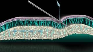 SIlhouette Soft Threadlifting at Nova Clinic Dubai screenshot 4