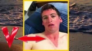 Worst Sunburns Ever