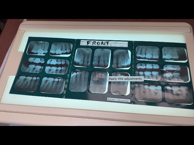 ☢️ FMX Dental X-ray Guide (Are They Safe?)