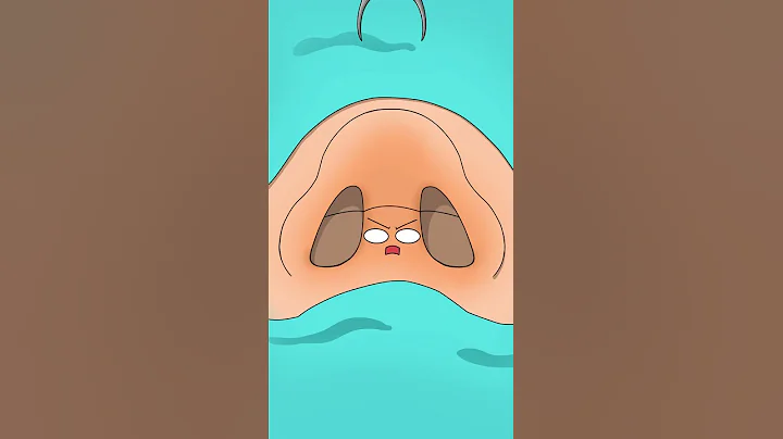Hump nose correction 驼峰鼻矫正 - 天天要闻