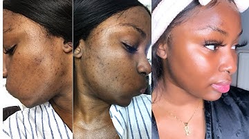 Updated skincare routine  + how I brightened dark marks/hyperpigmentation FT Nadula Hair