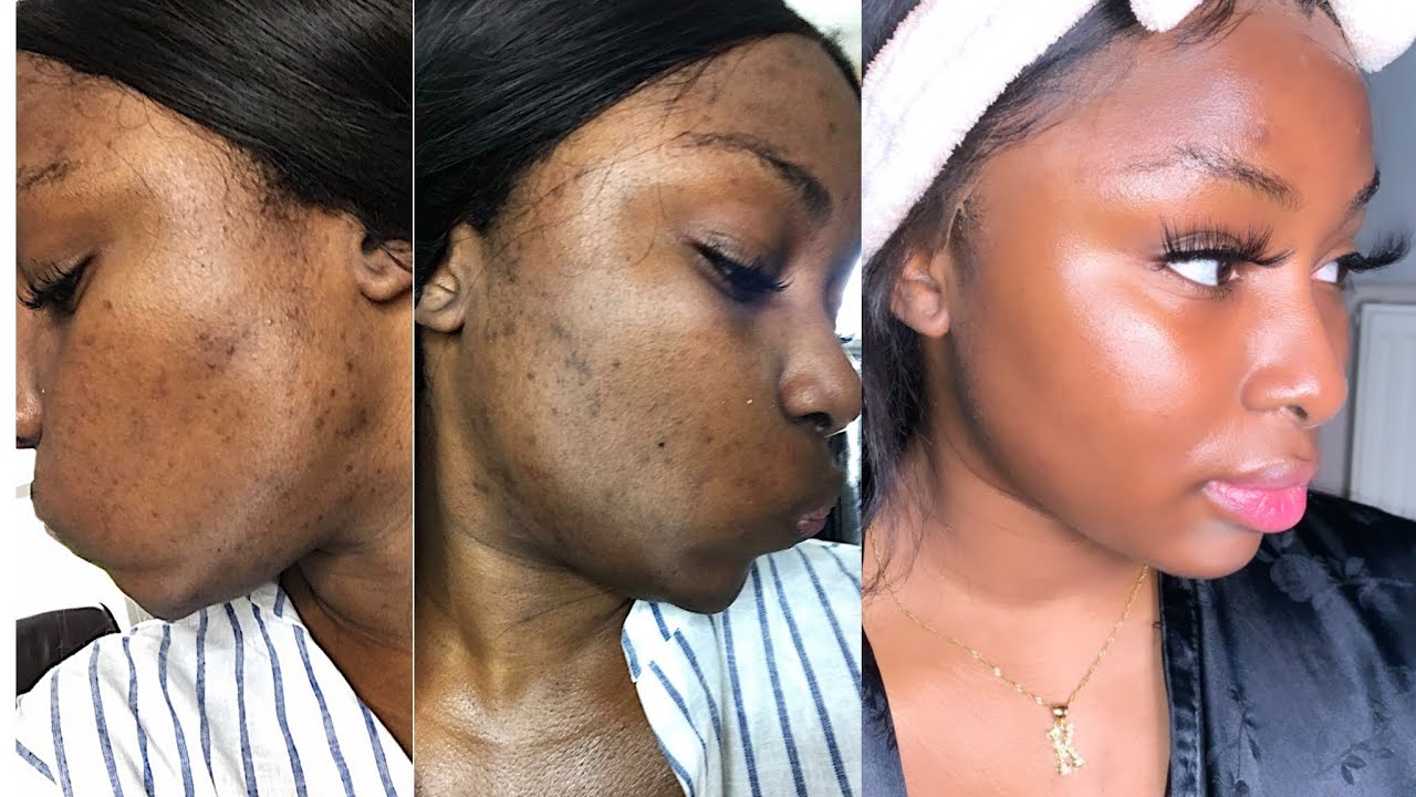 Updated skincare routine  + how I brightened dark marks/hyperpigmentation FT Nadula Hair