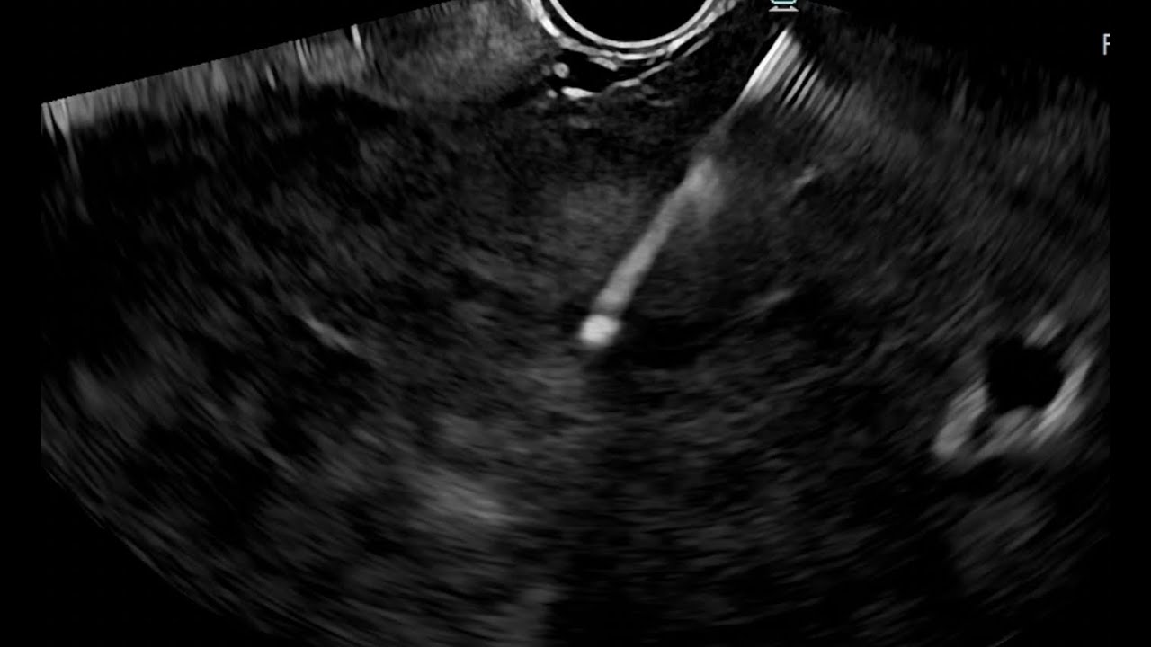Florida Live EUS Educational Video (August 17-19, 2023) - Liver mass in ...