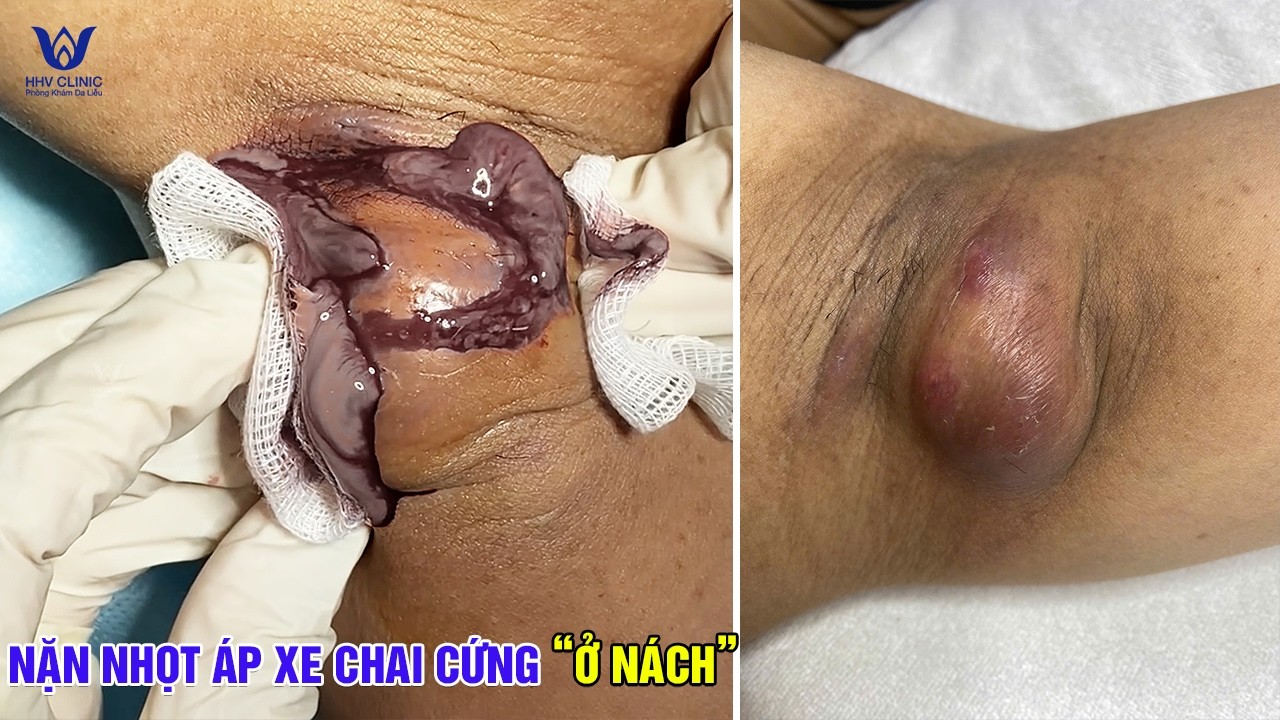 Mụn Áp Xe Căng Mủ Dưới Da Và Cái Kết Khi Được Xử Lý Đúng Cách.