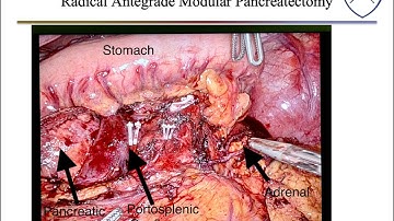 Distal Pancreatectomy
