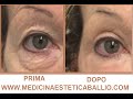 Blefaroplastica non chirurgica con Laser frazionato associato a PRP - Dr.ssa Ballio