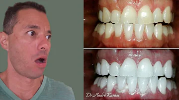 Quais os malefícios do clareamento dental?