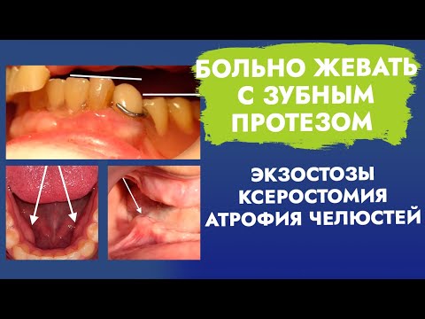 Больно жевать с зубным протезом. Экзостозы. Ксеростомия. Атрофия челюстей.