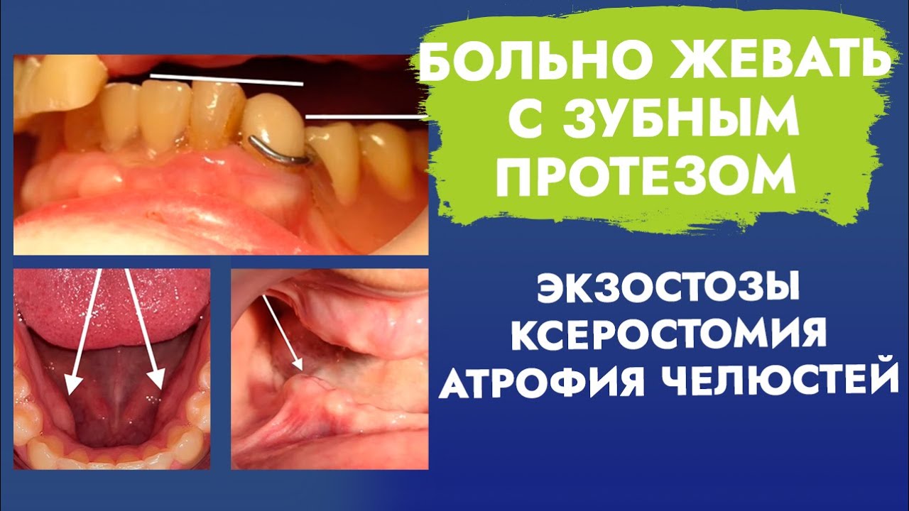 Больно жевать с зубным протезом. Экзостозы. Ксеростомия. Атрофия ...