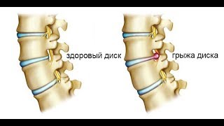 Как выглядит грыжа позвонков и почему не надо делать операцию!