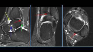 MRI Ankle Case 21
