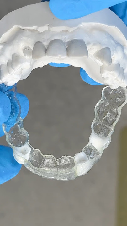 Filling in three teeth with an Essix Appliance #lsk121shorts #dentist #teeth