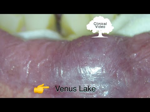 Venus Lake  removed with Solea laser.