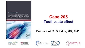 Case 205: Manual of PCI - Toothpaste effect