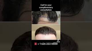 Before After FUE Hair Transplant 5 months post procedure in LA, Los Angeles with LA FUE Hair Clinic.