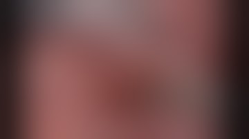 Fissureless Robotic Right Upper Lobectomy with step-by-step narration