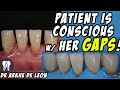 Closing The Patient's Gaps with Direct Composite Technique #C24