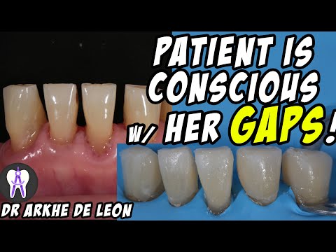 Closing The Patient's Gaps with Direct Composite Technique #C24