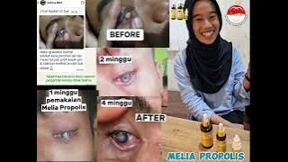 Testimoni Melia Propolis, mata membaik dari kerusakan kornea akibat terkena percikan api mesin las