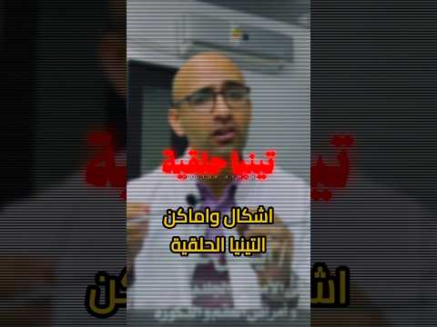 ما هي التينيا الحلقية سببها و اشكالها