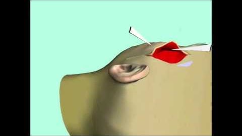 Dermal and Subdermal Incision Simulations, CGGC Technion