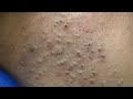 [ASMR] Blackhead and Whitehead Removal with Deep Cleansing Techniques