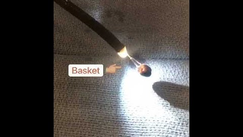 Non-Surgical Gallstone Removal -Without Removal of Gallbladder Live Video #removal #gallstone