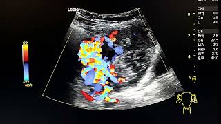 ultrasound case of a cystic adnexal mass - left ectopic pregnancy Complex Adnexal Cyst Ultrasound Case 27