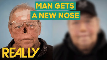 Man With GAPING HOLE Gets A New Nose | The Face Doctors