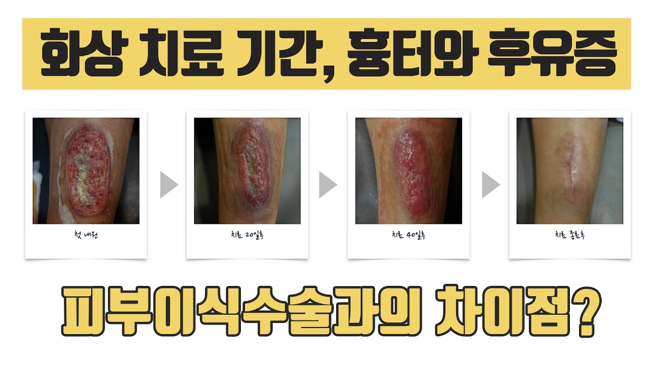 화상치료 FAQ 2탄_화상 치료 기간, 흉터와 후유증, 피부이식수술과 한의원 치료의 차이점 - YouTube