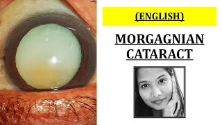 What is a 'Morgagnian Cataract'? | Ophthalmology screenshot 3